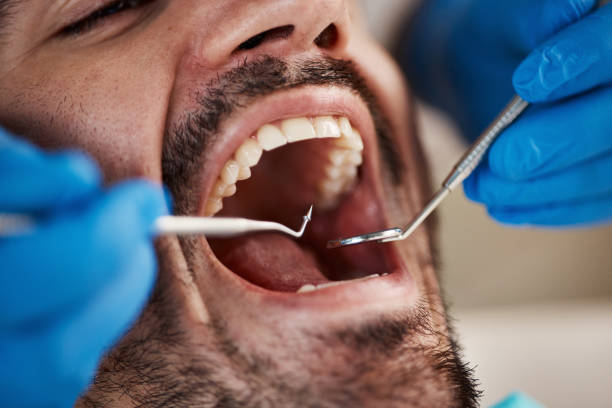 Best Emergency Dentist for Lost Fillings or Crowns in Pocono Ranch Lands, PA